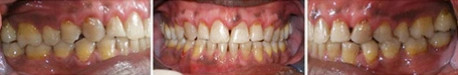 Close up front view of a patient's teeth after orthodontic treatment at Cranston Orthodontics