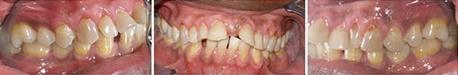Close up front view of a patient's teeth before orthodontic treatment at Cranston Orthodontics