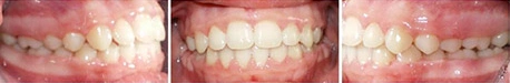 Close up front view of a patient's teeth after orthodontic treatment at Cranston Orthodontics