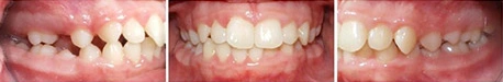 Close up front view of a patient's teeth before orthodontic treatment at Cranston Orthodontics