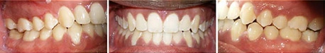 Close up front view of a patient's teeth after orthodontic treatment at Cranston Orthodontics