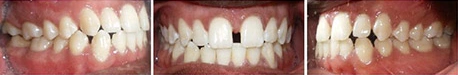 Close up front view of a patient's teeth before orthodontic treatment at Cranston Orthodontics