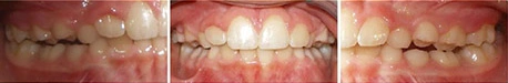 Close up front view of a patient's teeth after orthodontic treatment at Cranston Orthodontics