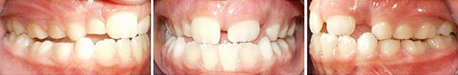 Close up front view of a patient's teeth before orthodontic treatment at Cranston Orthodontics