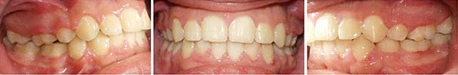 Close up front view of a patient's teeth after orthodontic treatment at Cranston Orthodontics