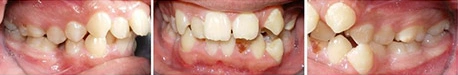 Close up front view of a patient's teeth before orthodontic treatment at Cranston Orthodontics
