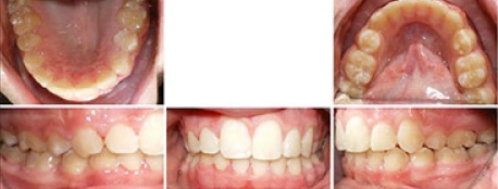 Close up front view of a patient's teeth after orthodontic treatment at Cranston Orthodontics
