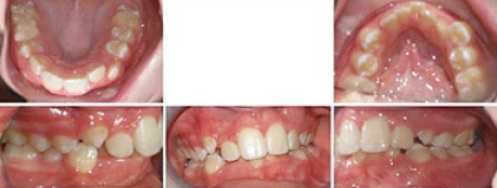 Close up front view of a patient's teeth before orthodontic treatment at Cranston Orthodontics