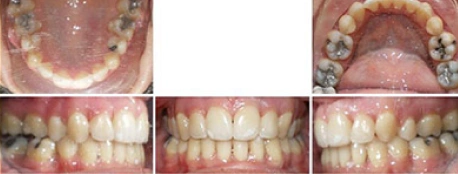 Close up front view of a patient's teeth after orthodontic treatment at Cranston Orthodontics