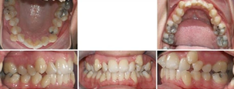 Close up front view of a patient's teeth before orthodontic treatment at Cranston Orthodontics