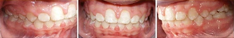 Close up front view of a patient's teeth after orthodontic treatment at Cranston Orthodontics