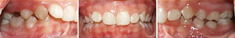 Close up front view of a patient's teeth before orthodontic treatment at Cranston Orthodontics