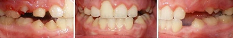 Close up front view of a patient's teeth after orthodontic treatment at Cranston Orthodontics