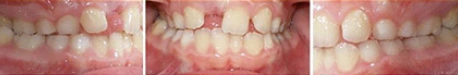 Close up front view of a patient's teeth before orthodontic treatment at Cranston Orthodontics