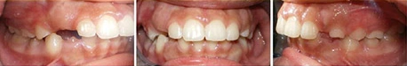 Close up front view of a patient's teeth after orthodontic treatment at Cranston Orthodontics