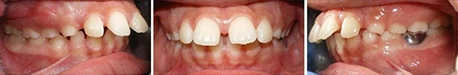 Close up front view of a patient's teeth before orthodontic treatment at Cranston Orthodontics