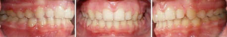 Close up front view of a patient's teeth after orthodontic treatment at Cranston Orthodontics