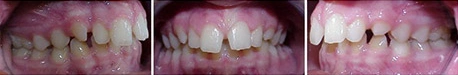 Close up front view of a patient's teeth before orthodontic treatment at Cranston Orthodontics