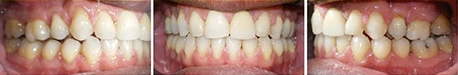 Close up front view of a patient's teeth after orthodontic treatment at Cranston Orthodontics