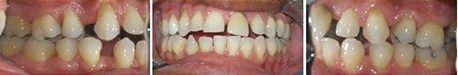 Close up front view of a patient's teeth before orthodontic treatment at Cranston Orthodontics