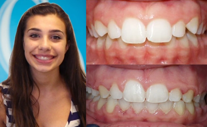Close up front view of a patient's teeth before and after orthodontic treatment at Cranston Orthodontics