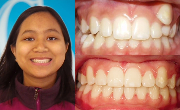 Close up front view of a patient's teeth before and after orthodontic treatment at Cranston Orthodontics
