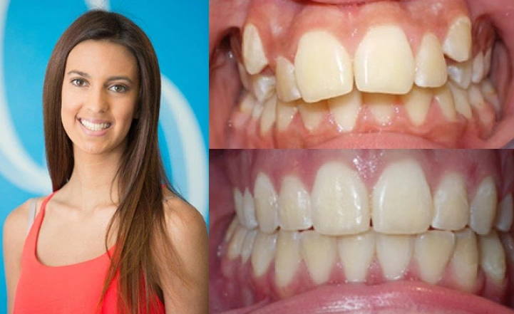 Close up front view of a patient's teeth before and after orthodontic treatment at Cranston Orthodontics