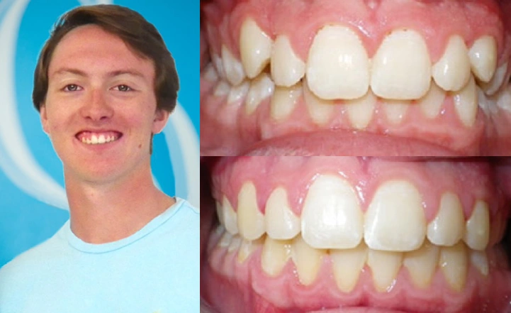 Close up front view of a patient's teeth before and after orthodontic treatment at Cranston Orthodontics