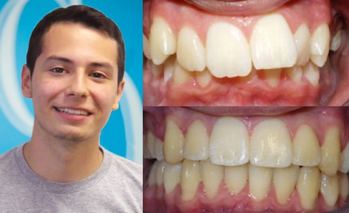 Close up front view of a patient's teeth before and after orthodontic treatment at Cranston Orthodontics