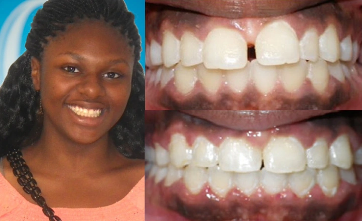 Close up front view of a patient's teeth before and after orthodontic treatment at Cranston Orthodontics