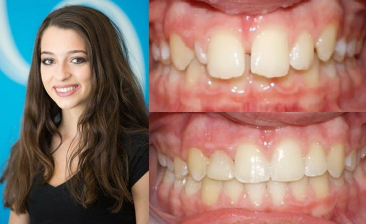 Close up front view of a patient's teeth before and after orthodontic treatment at Cranston Orthodontics