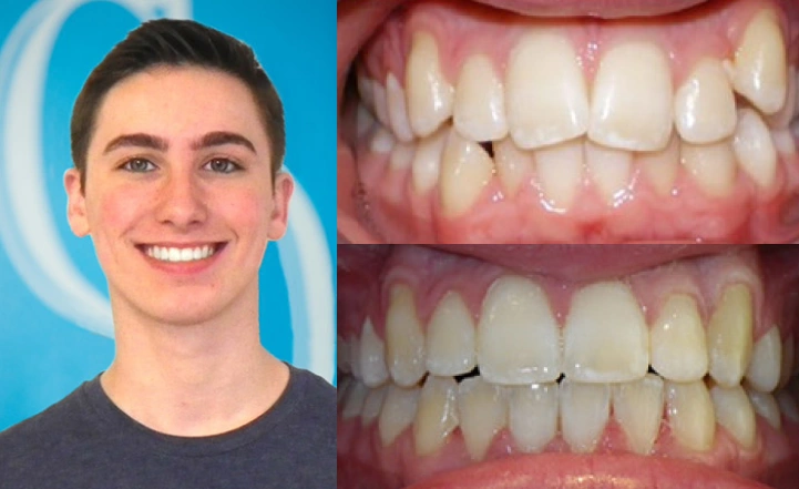 Close up front view of a patient's teeth before and after orthodontic treatment at Cranston Orthodontics