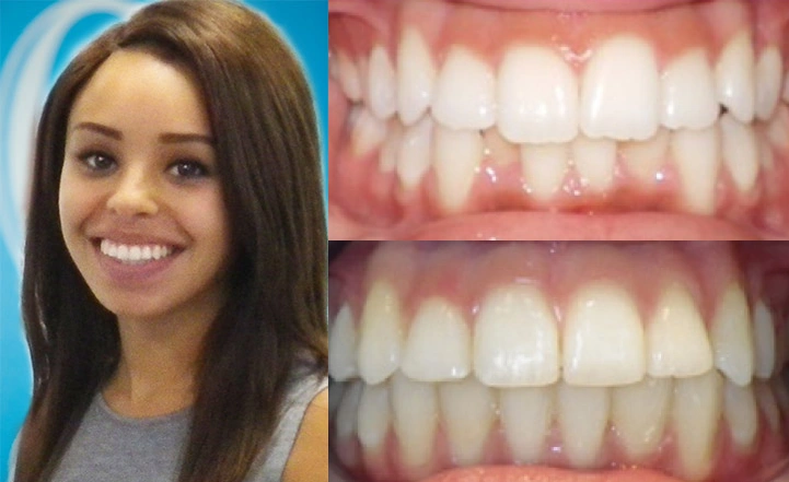 Close up front view of a patient's teeth before and after orthodontic treatment at Cranston Orthodontics