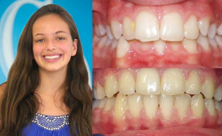 Close up front view of a patient's teeth before and after orthodontic treatment at Cranston Orthodontics