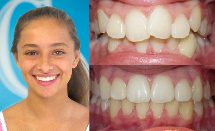 Close up front view of a patient's teeth before and after orthodontic treatment at Cranston Orthodontics