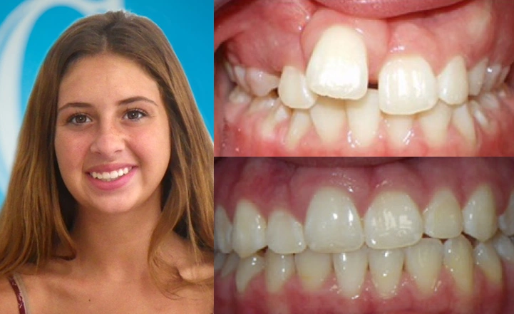 Close up front view of a patient's teeth before and after orthodontic treatment at Cranston Orthodontics