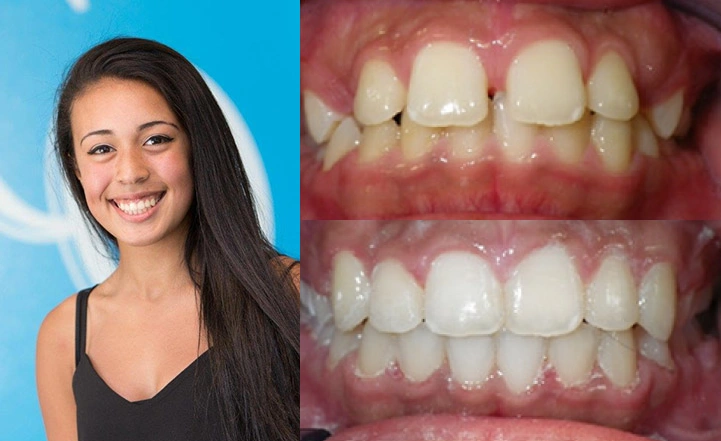 Close up front view of a patient's teeth before and after orthodontic treatment at Cranston Orthodontics