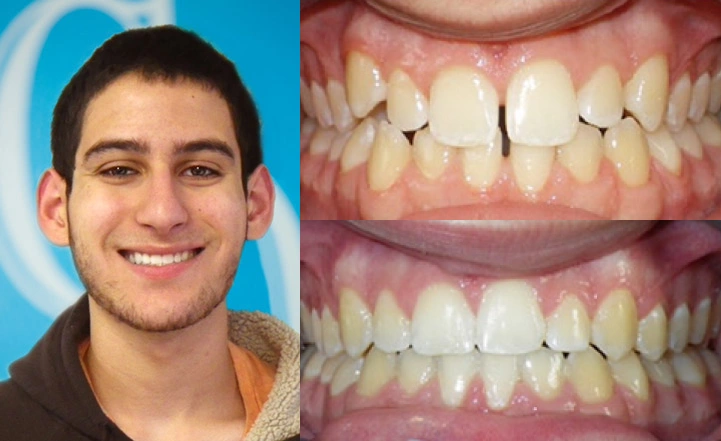 Close up front view of a patient's teeth before and after orthodontic treatment at Cranston Orthodontics