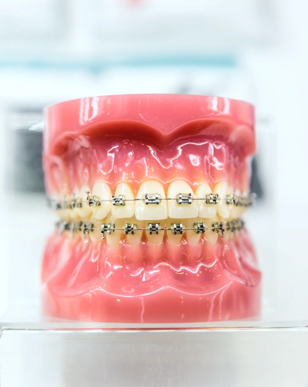 Dental model showing braces used for orthodontic treatment