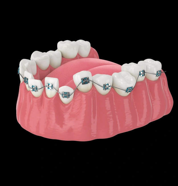 Dental model showing braces used for orthodontic treatment