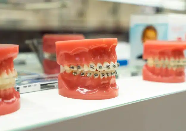 Dental model with braces displayed in the Cranston Orthodontics office
