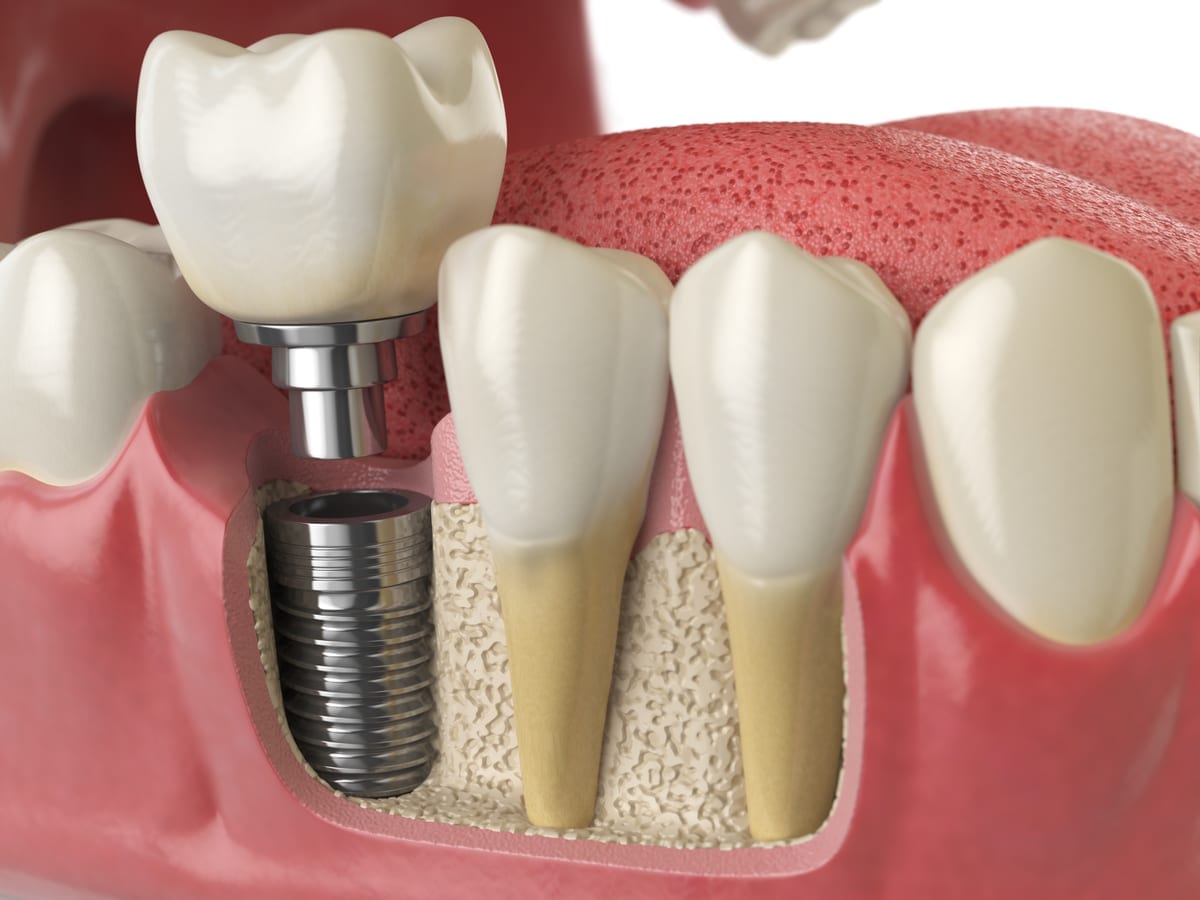 Dental Implants in Crystal Lake