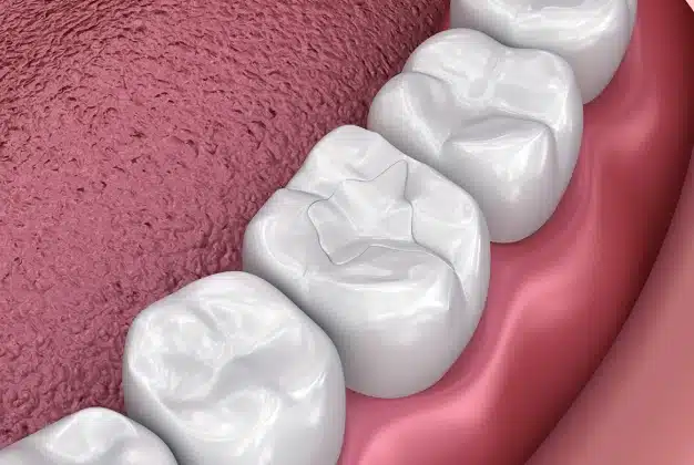 composite fillings