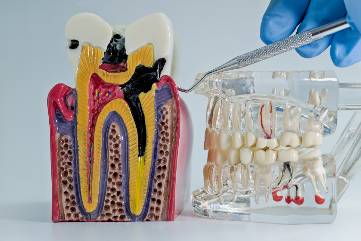 Root-Canal-Treatment-in-McKinney