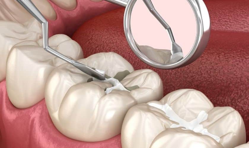 Dental Fillings in South Austin TX