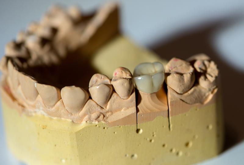 dental-crowns-in-south-austin