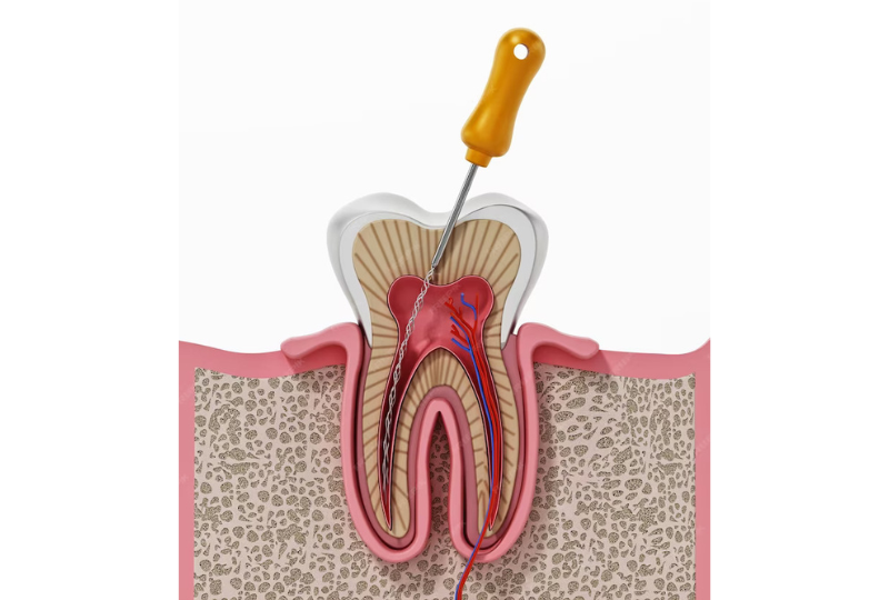 Illustrated cross section of a tooth showing the root canal pulp and surrounding bone