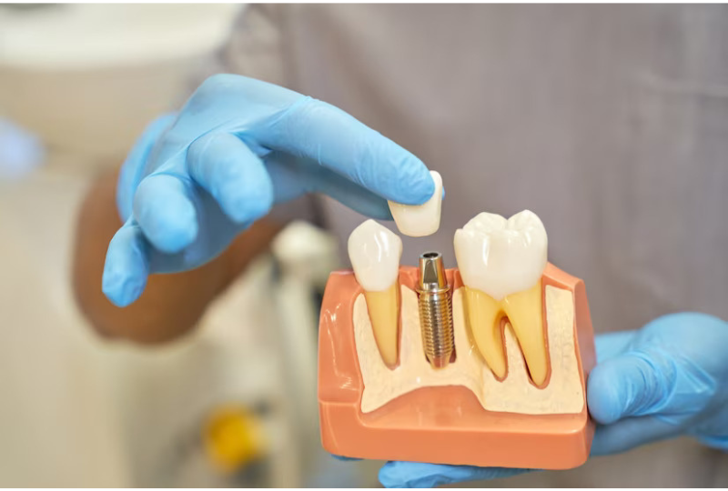 3D illustration of a dental implant post and crown placed in the jawbone