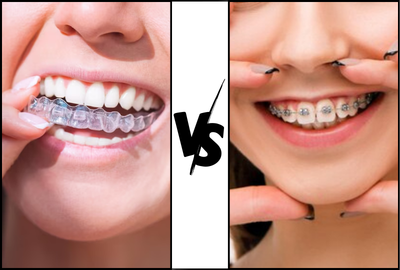 Imagen comparativa dividida de Invisalign frente a los brackets metálicos tradicionales.