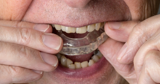 Primer plano de un hombre que lleva una férula de alineación transparente en los dientes superiores.